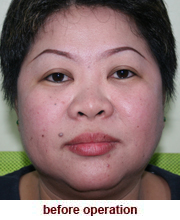 plastic_surgery_augmentation_rhinoplasty